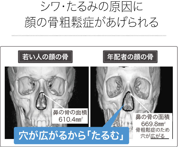 顔の骨が年を取ると少なくなっていく説明画像